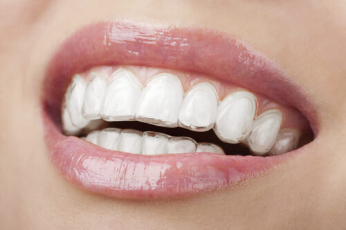 Photo After Winsdom Tooth Removal
