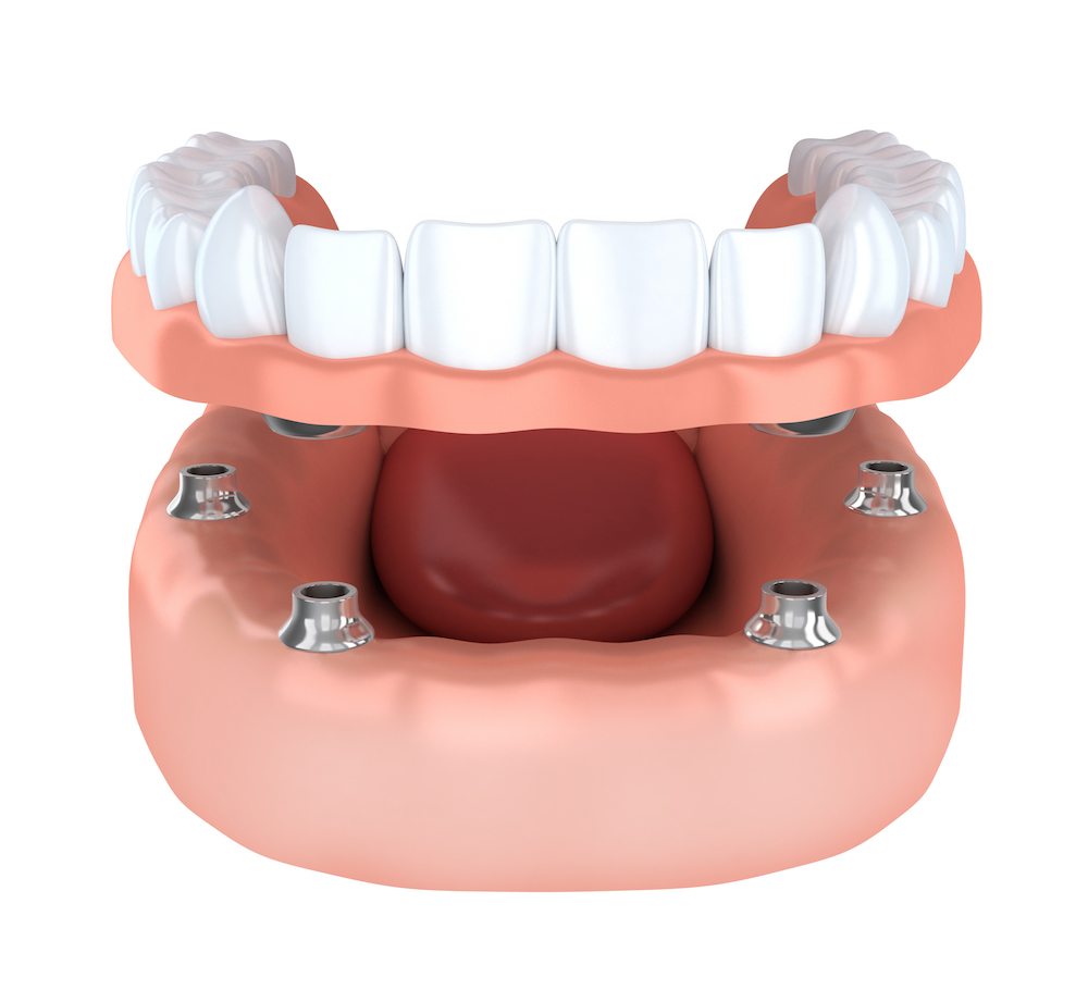 Photo for All on 4 Implants