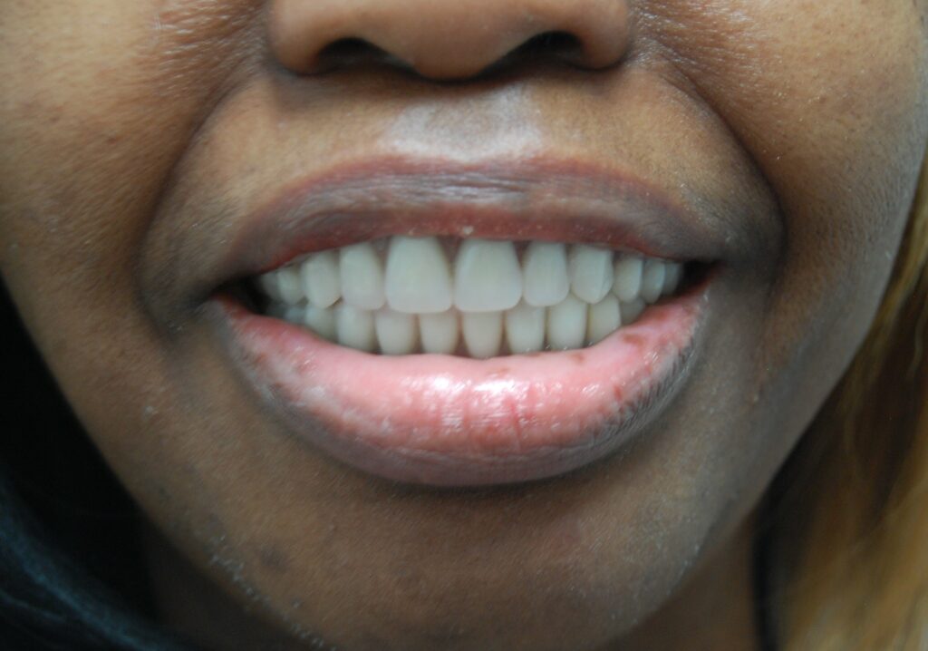 Photo of Before and After Implants 4