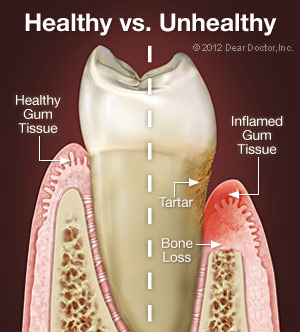 Photo of Periodontal Disease