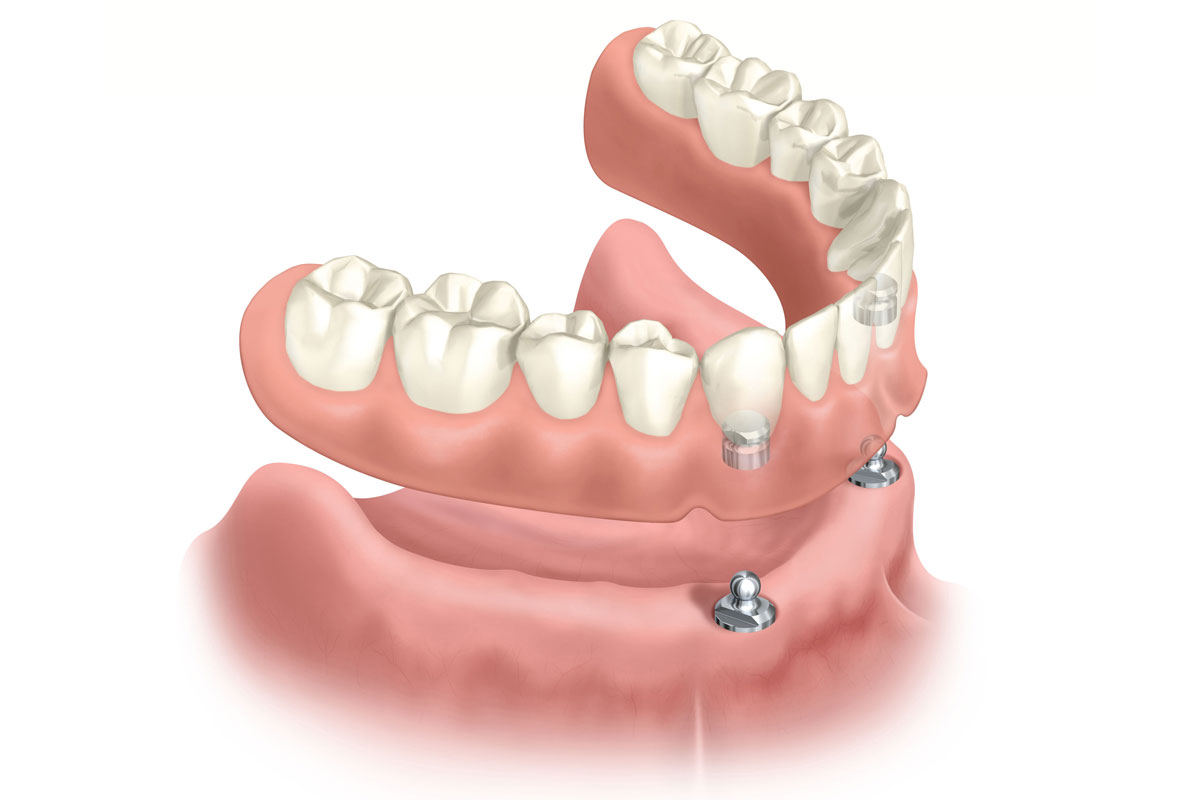 Photo of Snap on Dentures
