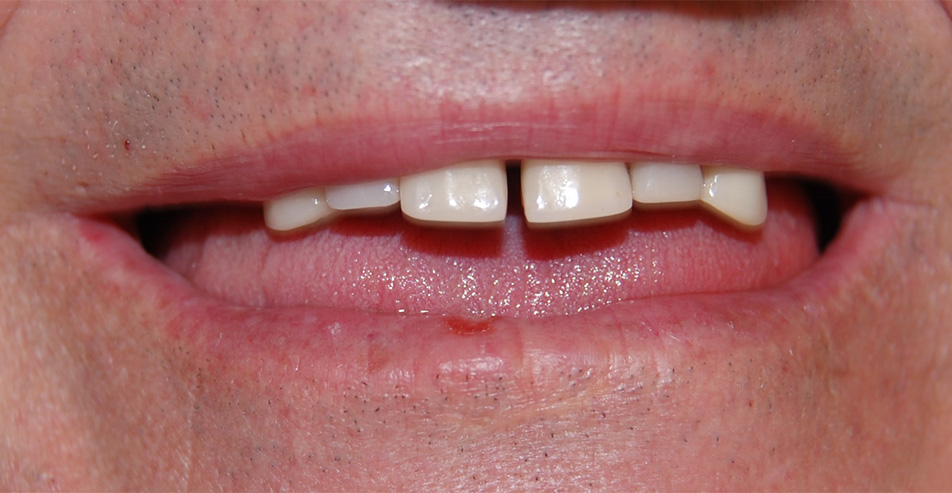 Photo of Before and After Implants 1