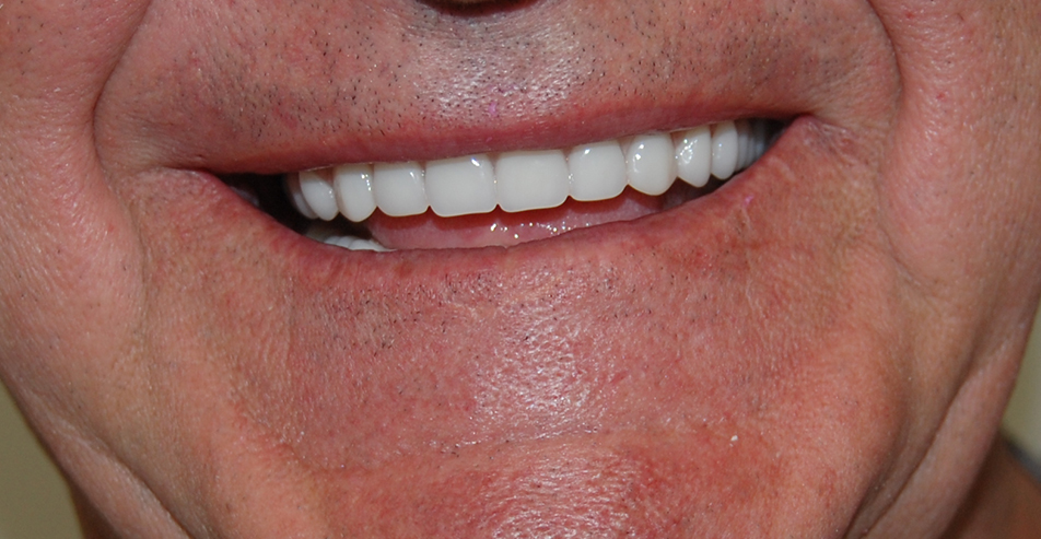 Photo of Before and After Implants 2